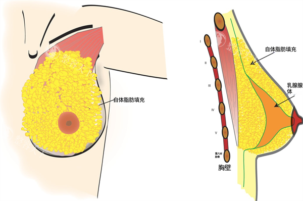 自体脂肪填充隆胸内部图