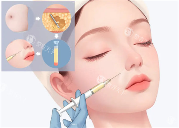 自体脂肪填充整形手术图片