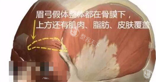 膨体眉弓发炎压迫神经怎么取出？高难度异物取出指南附3千到2万收费标准