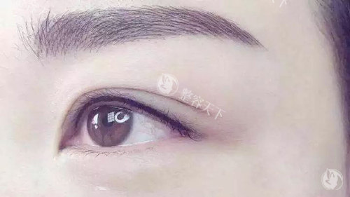 双眼皮实拍