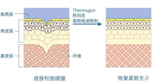 热玛吉作用在皮肤上皮下组织展示