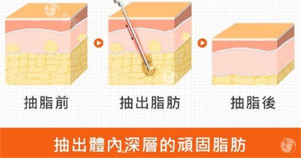 吸脂真的能瘦吗？体重没怎么掉但腰围少了8厘米，说说怎么回事