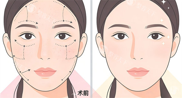 痘痘肌做光子嫩肤真的能改善吗？做了六次后的素颜记录
