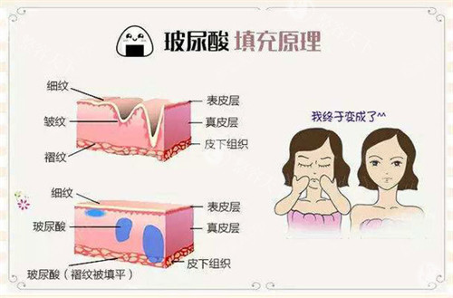 玻尿酸注射填充原理动画演示图.jpg