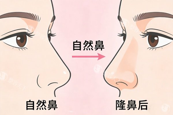 自然鼻型隆鼻前后对比图