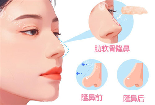 超肋骨隆鼻整形手术卡通图