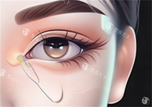 开眼角手术.jpg