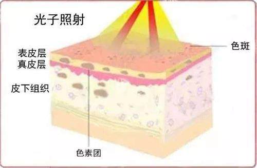 光子嫩肤的示意图..jpeg