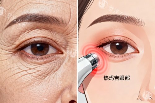 热玛吉眼部前后对比图.jpg