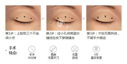 双眼皮三点术过程特点.jpg