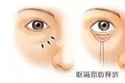 上眼皮凹陷显得疲惫？眶隔脂肪释放重回饱满少女眼，建议用Very美学小程序获取医生出诊时间