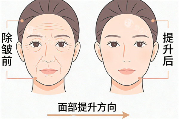 面部提升除皱前后对比