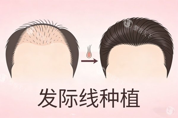 发际线种植前后对比图展示.jpg