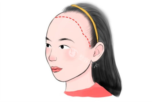 女型发际线种植卡通.jpg