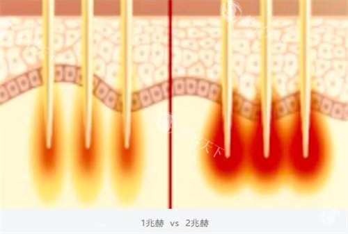 黑曜双波黄金微针双波发射模式.jpg