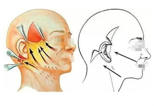 拉皮手术前后提拉对比图.jpg