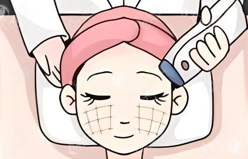 热玛吉操作过程.jpg