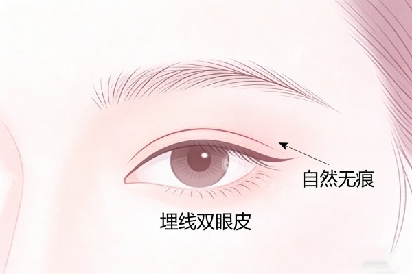 埋线双眼皮卡通图一览.jpg