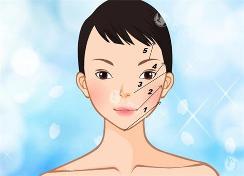 线提升