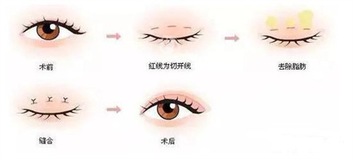 三点定位双眼皮手术过程.jpg