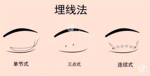 埋线双眼皮经过.png