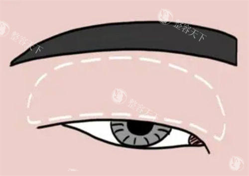 肿眼泡做双眼皮对比示意图.jpg