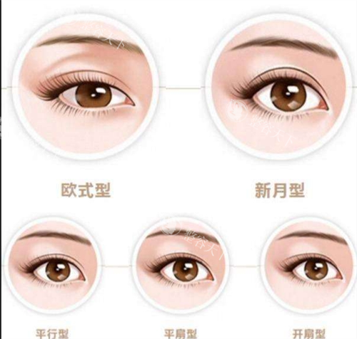 双眼皮类型图示.png