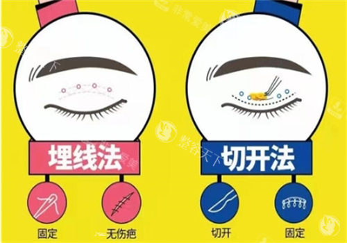 双眼皮埋线和切开对比图.png