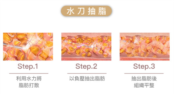 水刀抽脂原理.jpg