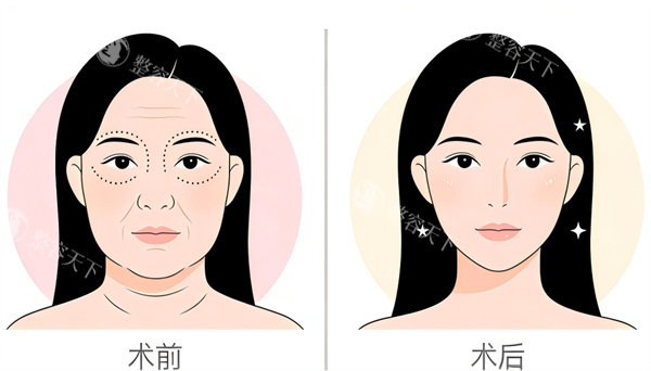 面部紧致提升手术前后对比.jpg