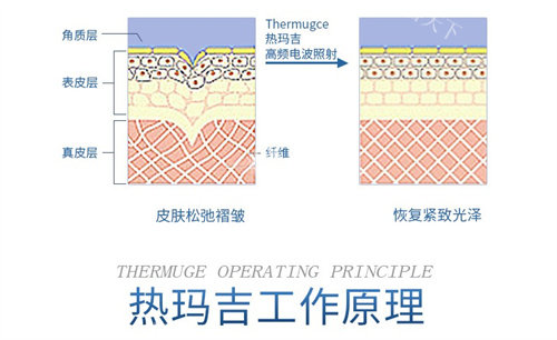 热玛吉工作示意图.jpg