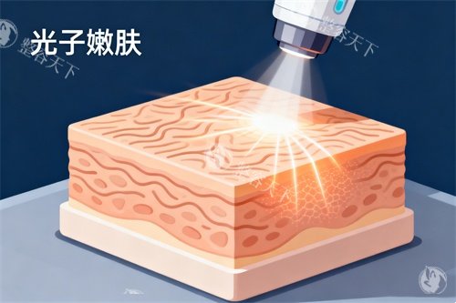 皮肤做光子嫩肤卡通图.jpg