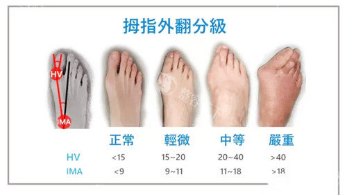 拇指外翻图.jpg
