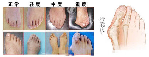 拇指外翻.jpg