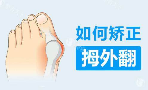 如何矫正拇外翻.jpg
