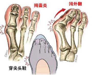 脚趾拇外翻卡通图照片.jpg