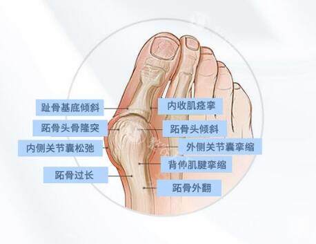 拇外翻原因分享.jpg