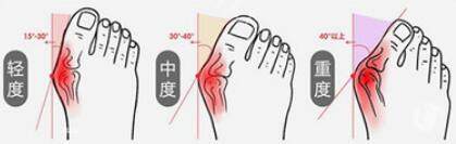 拇外翻大脚骨程度.jpg