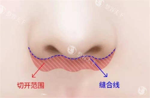 埋线人中缩短术手术位置图解.jpg
