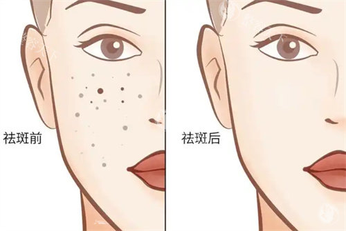 祛斑前后对比.jpg