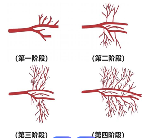 雷诺瓦治疗过程.png