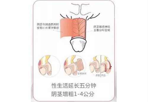 阴茎生物补片手术结果.jpg