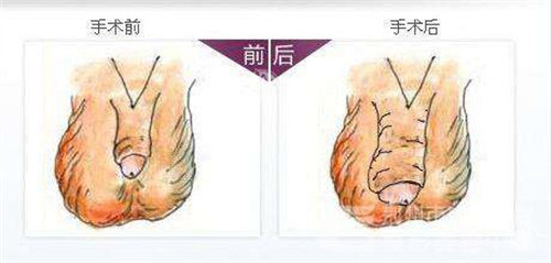 阴茎增粗手术前后对比图.jpg