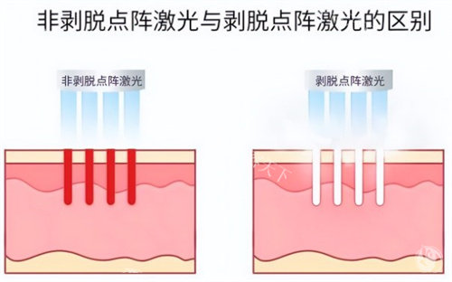 非剥脱点阵激光和剥脱点阵激光.jpg