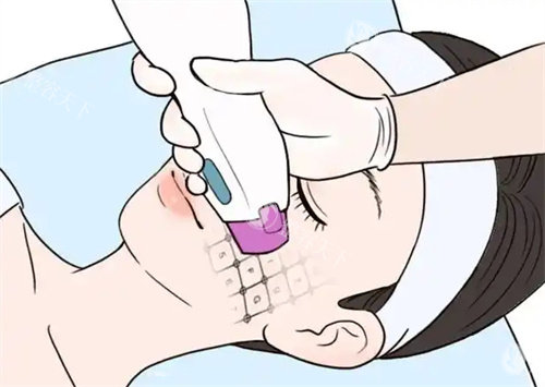 面部热玛吉卡通图片.jpg