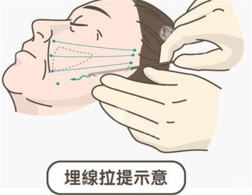 埋线提升面部的操作过程.jpg