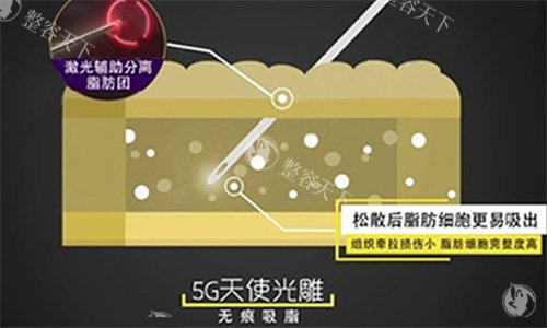 成美整形医院吸脂技术怎么样，医生靠不靠谱安全吗才是关心的重点