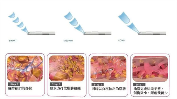 腰腹抽脂20天了感觉腰没有细了正常吗，这情况算不算恢复得慢？
