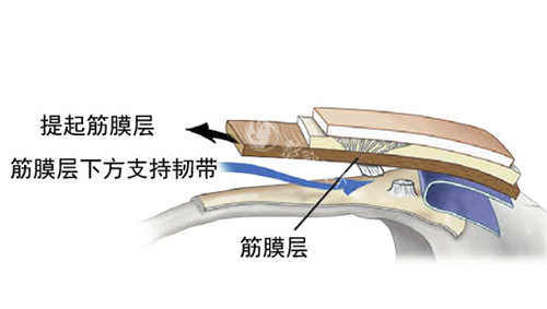 SMAS筋膜层图片展示