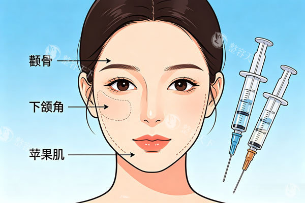 玻尿酸面部填充部位图